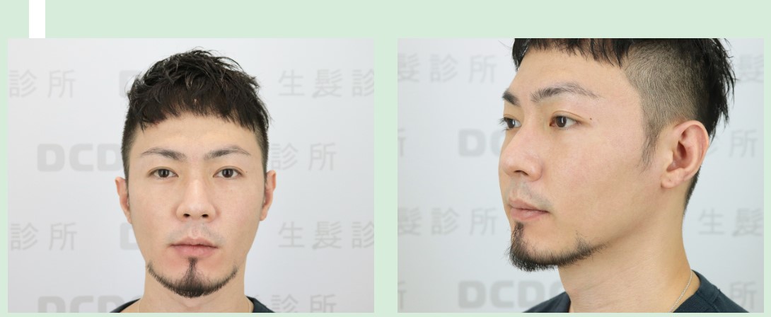 FUE術後變得自然又濃密